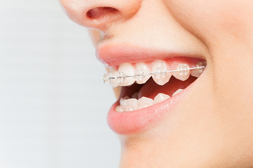 Invisalign or braces