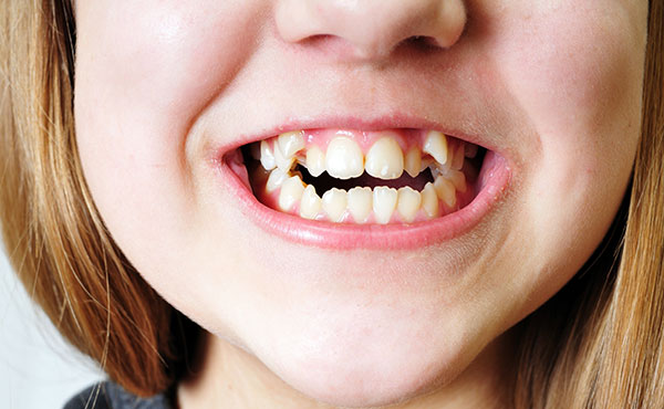 Child with open bite in need of orthodontic treatment