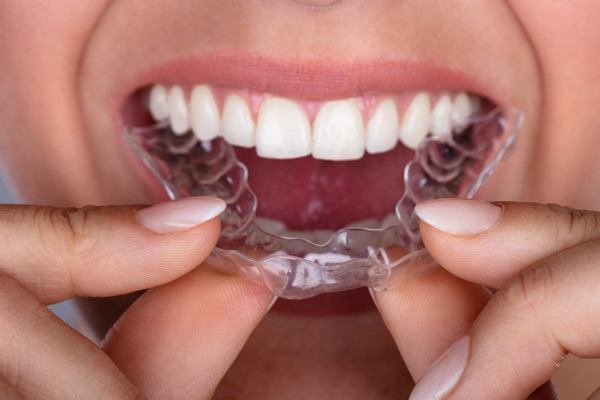 Close up of a patient putting clear aligners on her teeth at Raleigh Family Orthodontics in Raleigh, NC Close up of a patient putting clear aligners on her teeth at Raleigh Family Orthodontics in Raleigh, NC